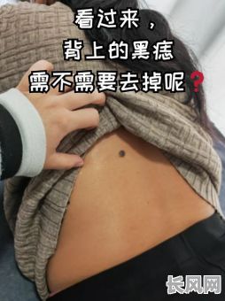 背心长肉痣究竟是什么命格?预示着怎样的命运?